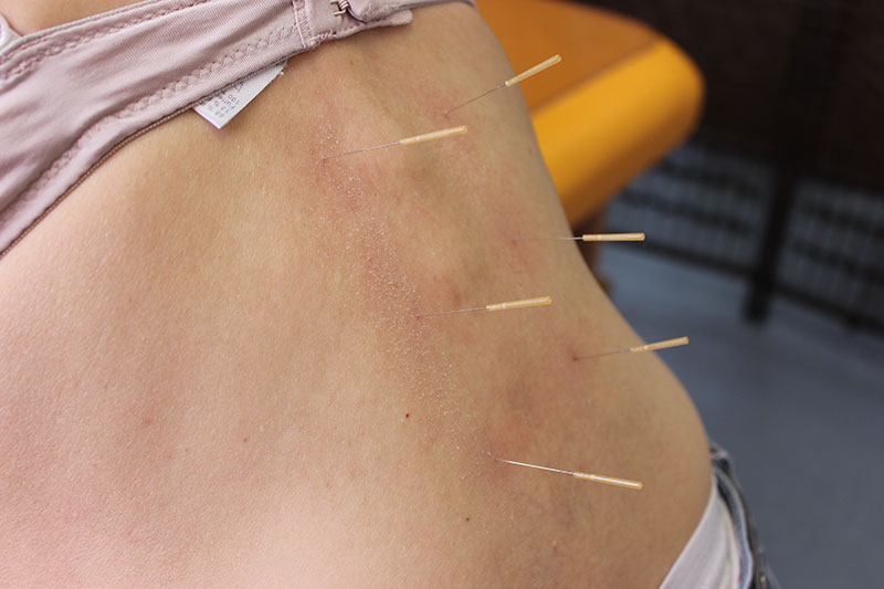 Akupunktur an der Wirbelsäule